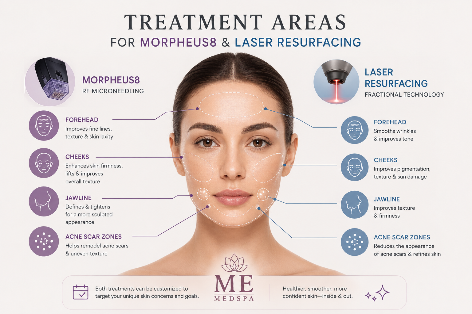 Illustration showing facial treatment areas commonly addressed with Morpheus8 and laser skin resurfacing