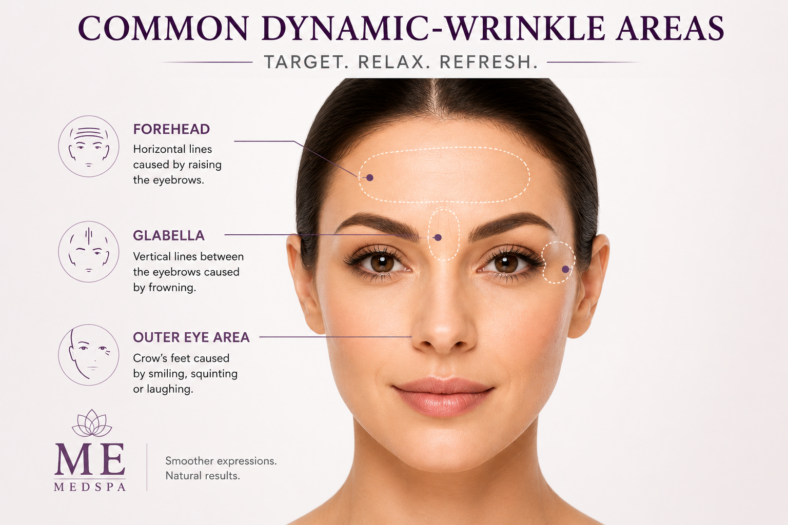 Face map showing common areas evaluated for neuromodulator wrinkle treatments
