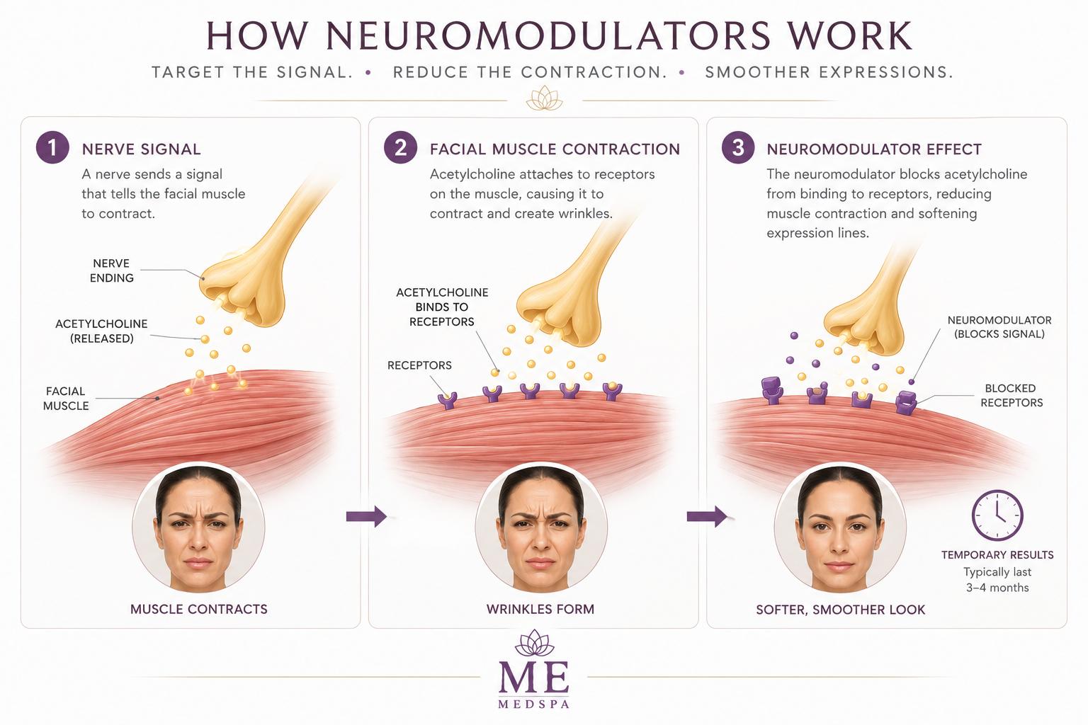 Medical illustration showing how neuromodulators temporarily reduce facial muscle activity