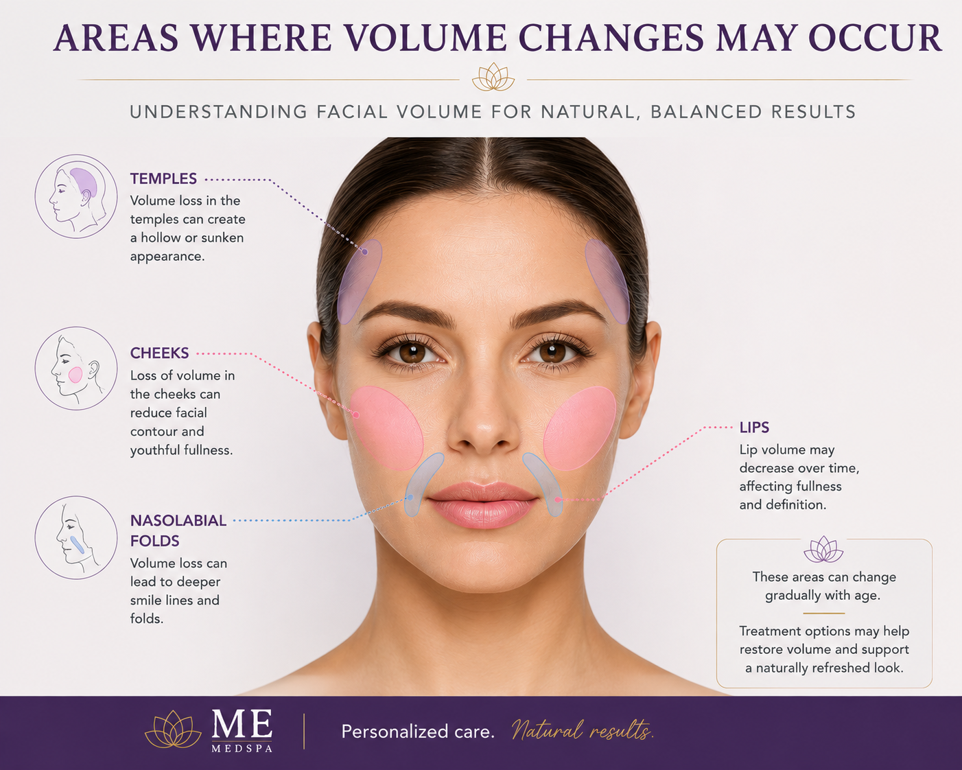Facial illustration showing common areas evaluated for dermal filler treatment