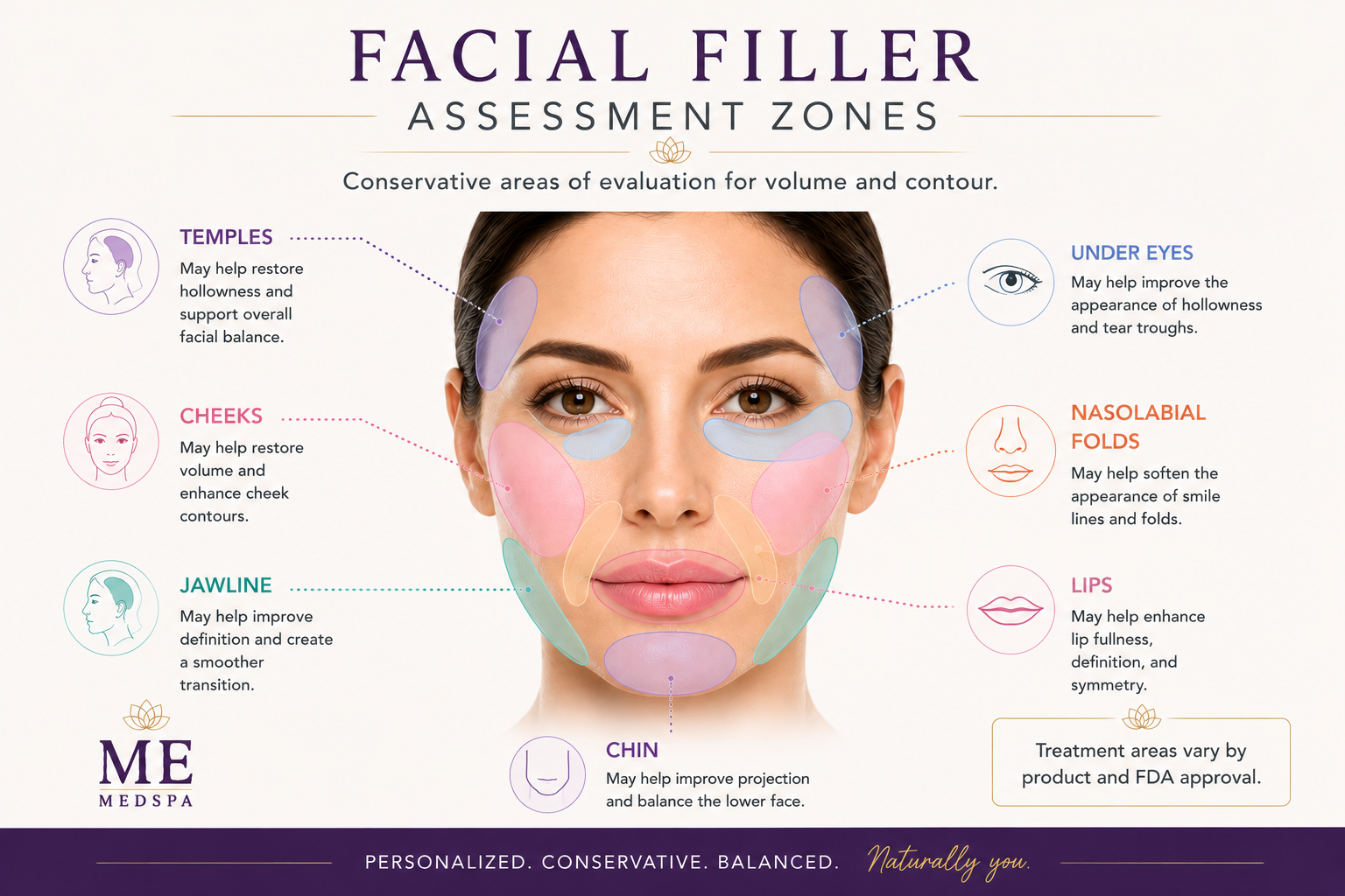 Educational face map showing areas that may be evaluated for dermal filler treatment