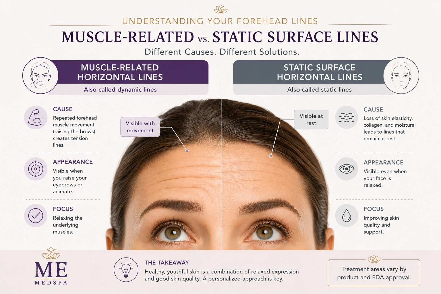 Educational illustration showing dynamic forehead lines evaluated for Botox treatment