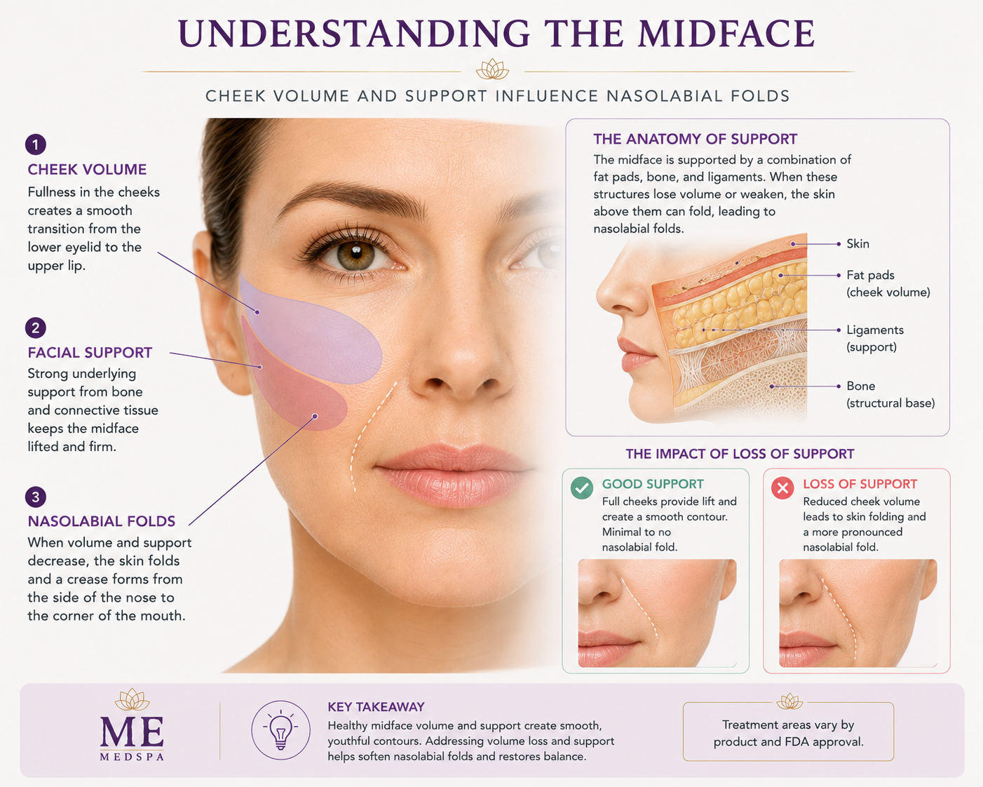 Illustration showing how cheek support and facial volume may influence nasolabial folds
