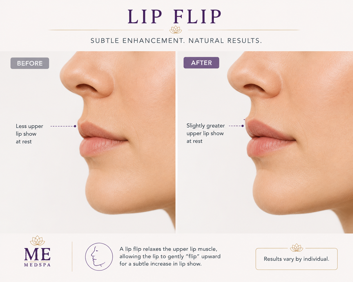Illustration showing how a lip flip may increase visible upper lip without adding filler volume