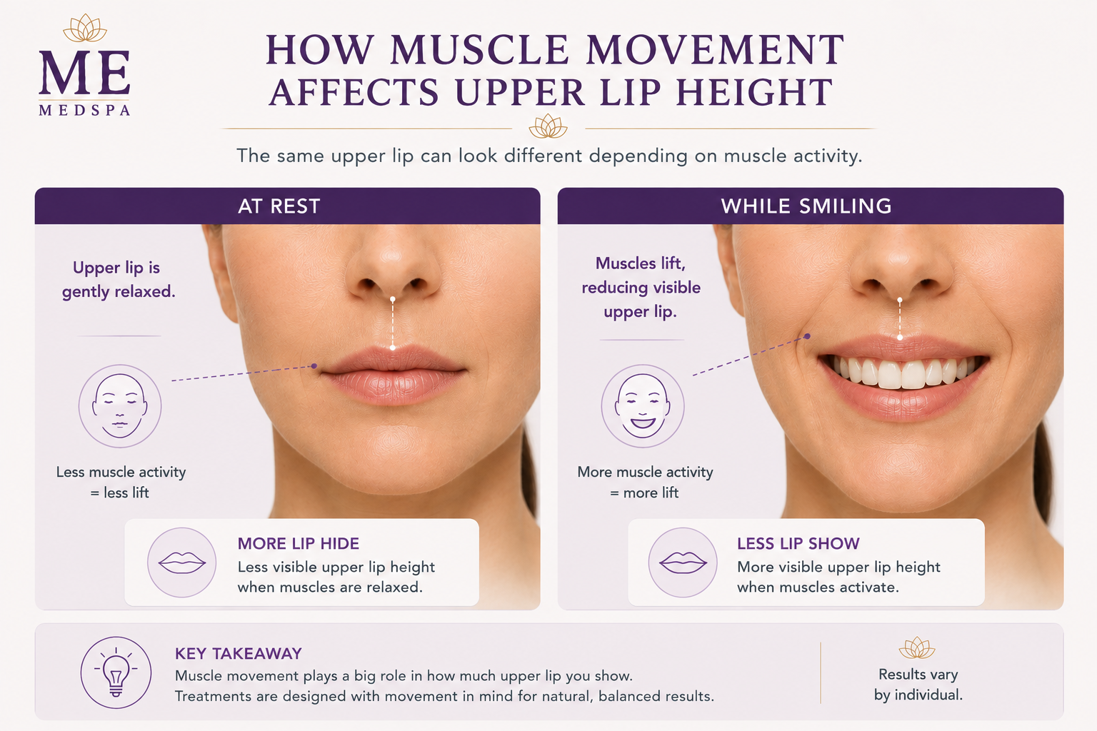Illustration showing how upper lip movement can affect visible lip size when smiling
