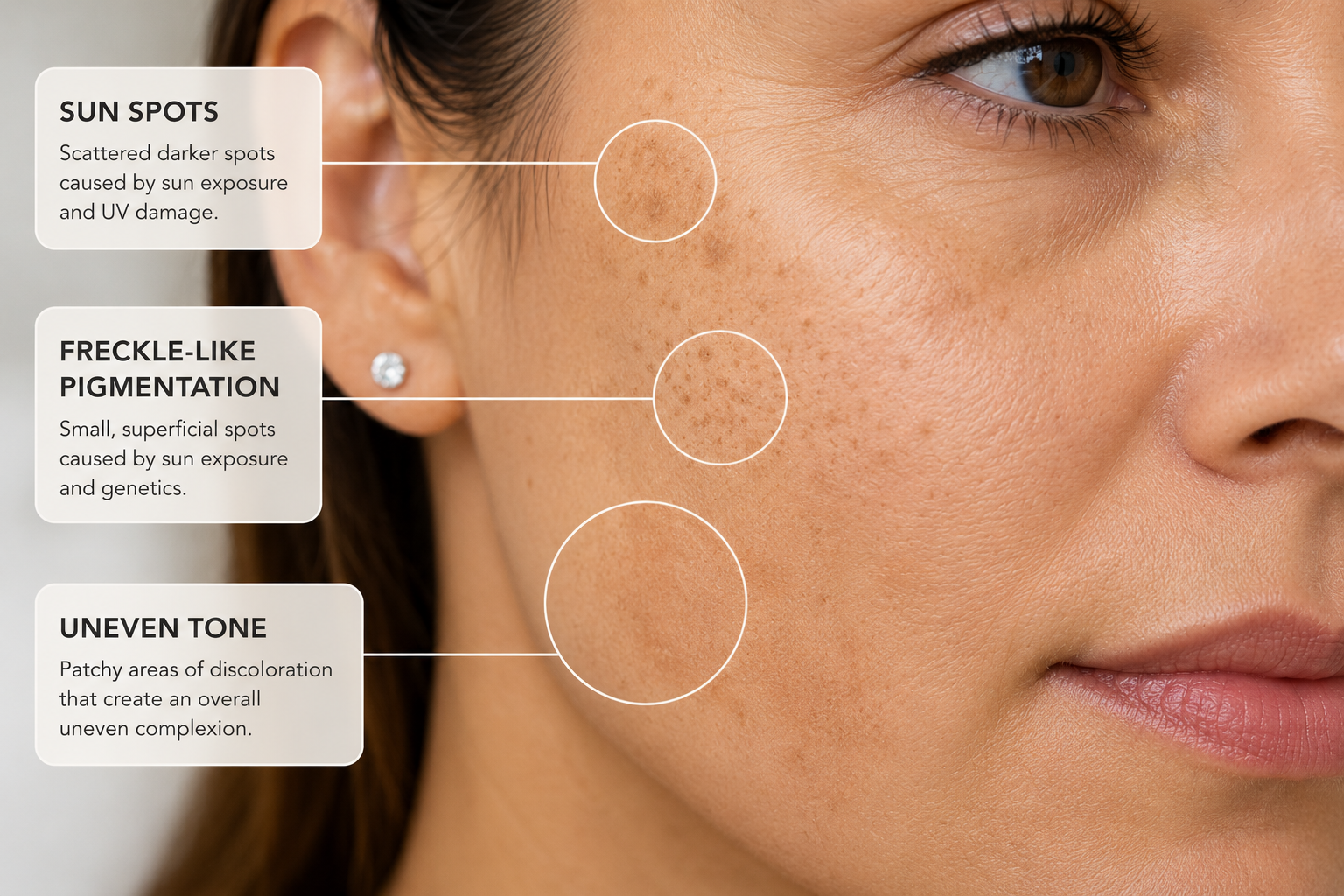 Examples of sun spots and uneven pigmentation that may be evaluated for IPL treatment