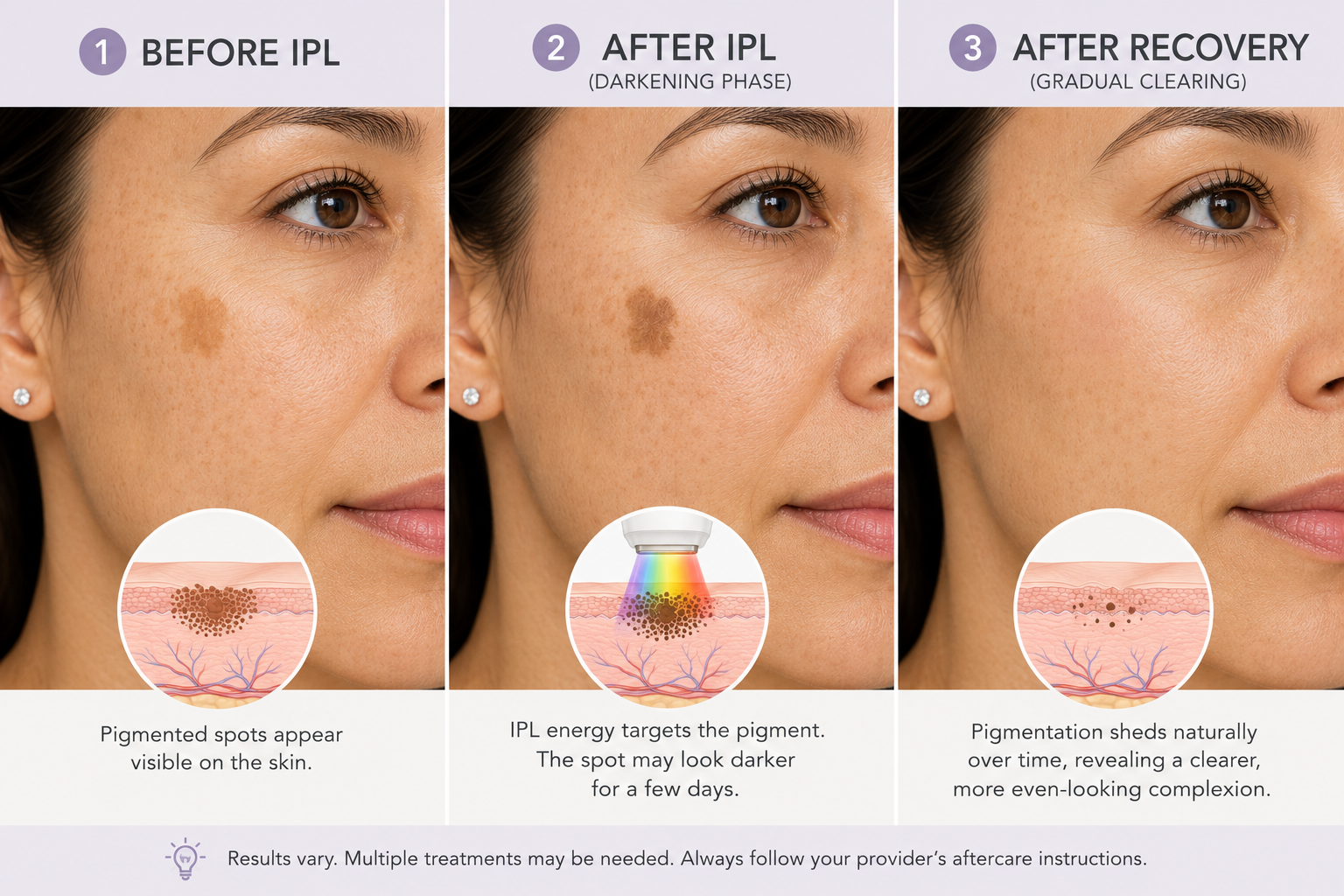 Illustration of temporary darkening and gradual change in pigmentation after IPL treatment