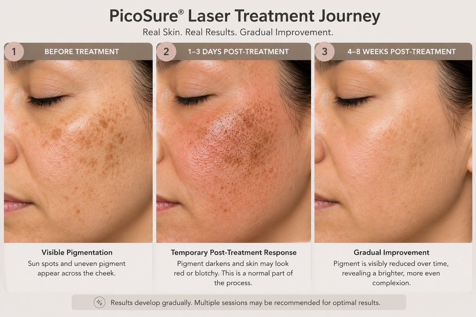Three-stage educational illustration of the same cheek area: visible pigmentation before treatment, temporary post-treatment response, and a later stage showing subtle improvement. Preserve natural skin texture and don't portray complete pigment removal.