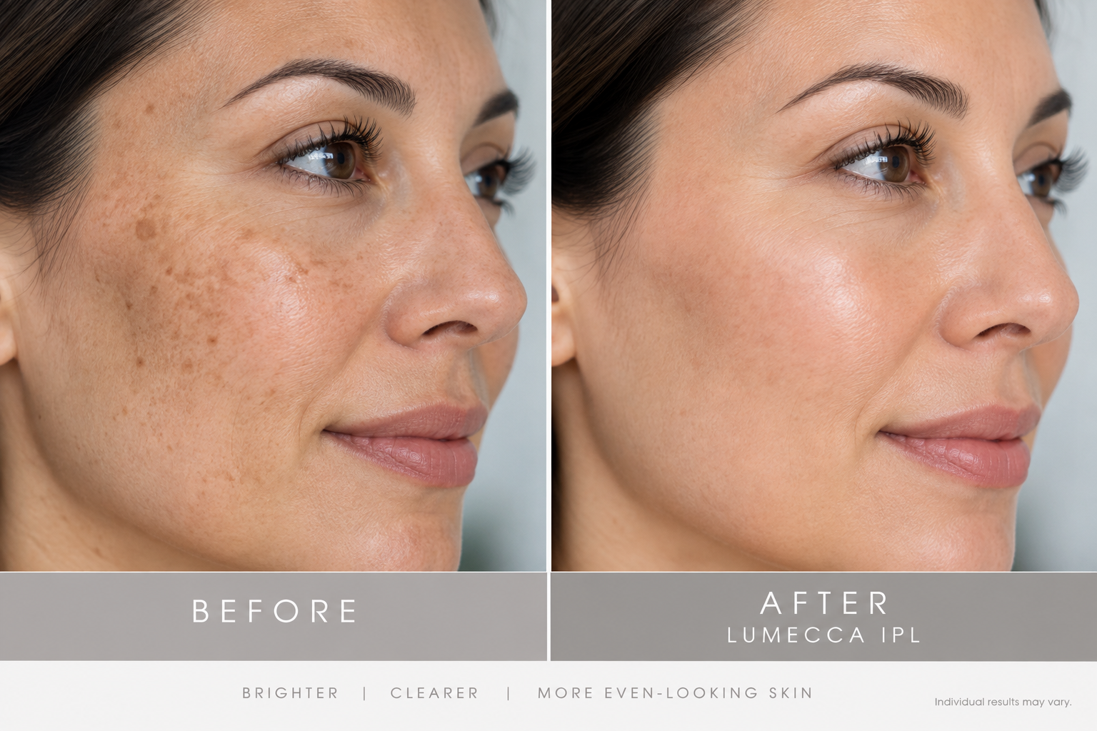 Before and after comparison showing reduced facial sun spots and a more even-looking skin tone following Lumecca IPL treatment Before and after comparison showing reduced facial sun spots and a more even-looking skin tone following Lumecca IPL treatment