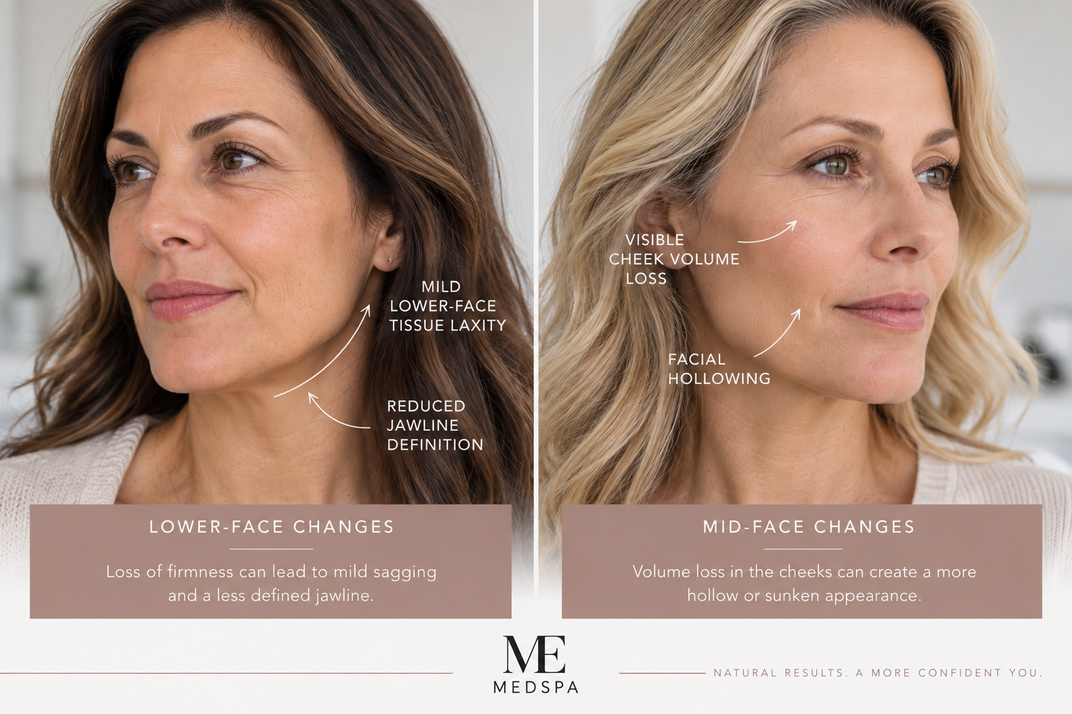 Comparison of facial tissue laxity and facial volume loss in two women
