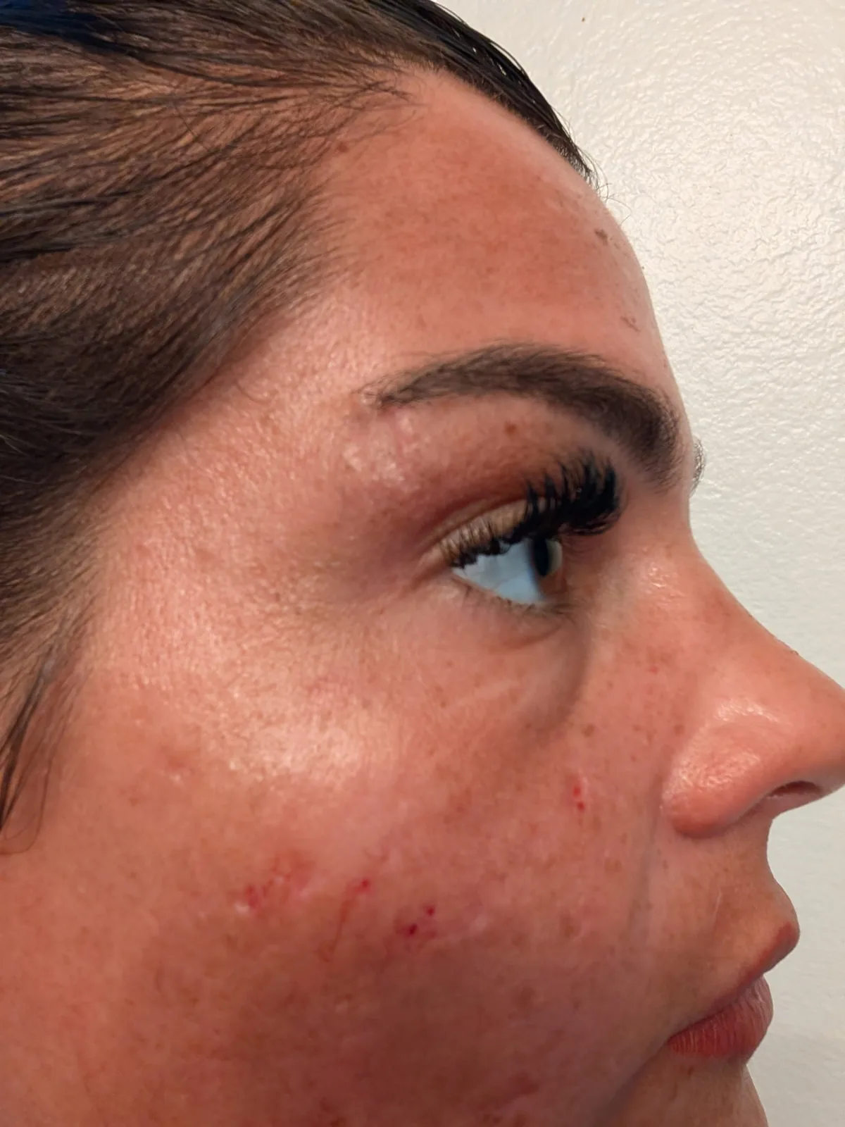 Inkless scar revision treatment session