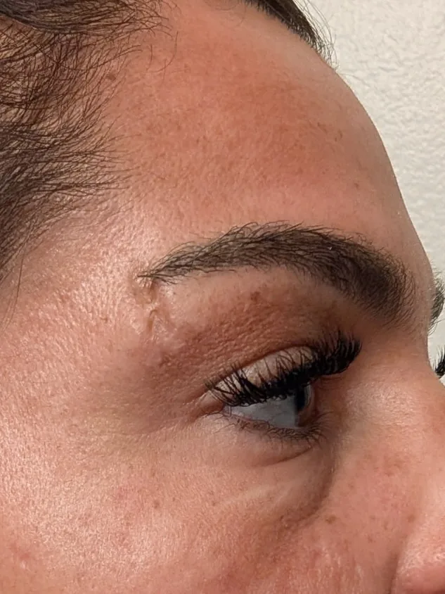 Brow-area scar close-up