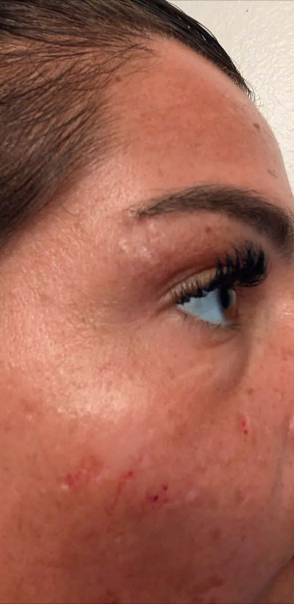 Inkless scar revision treatment session