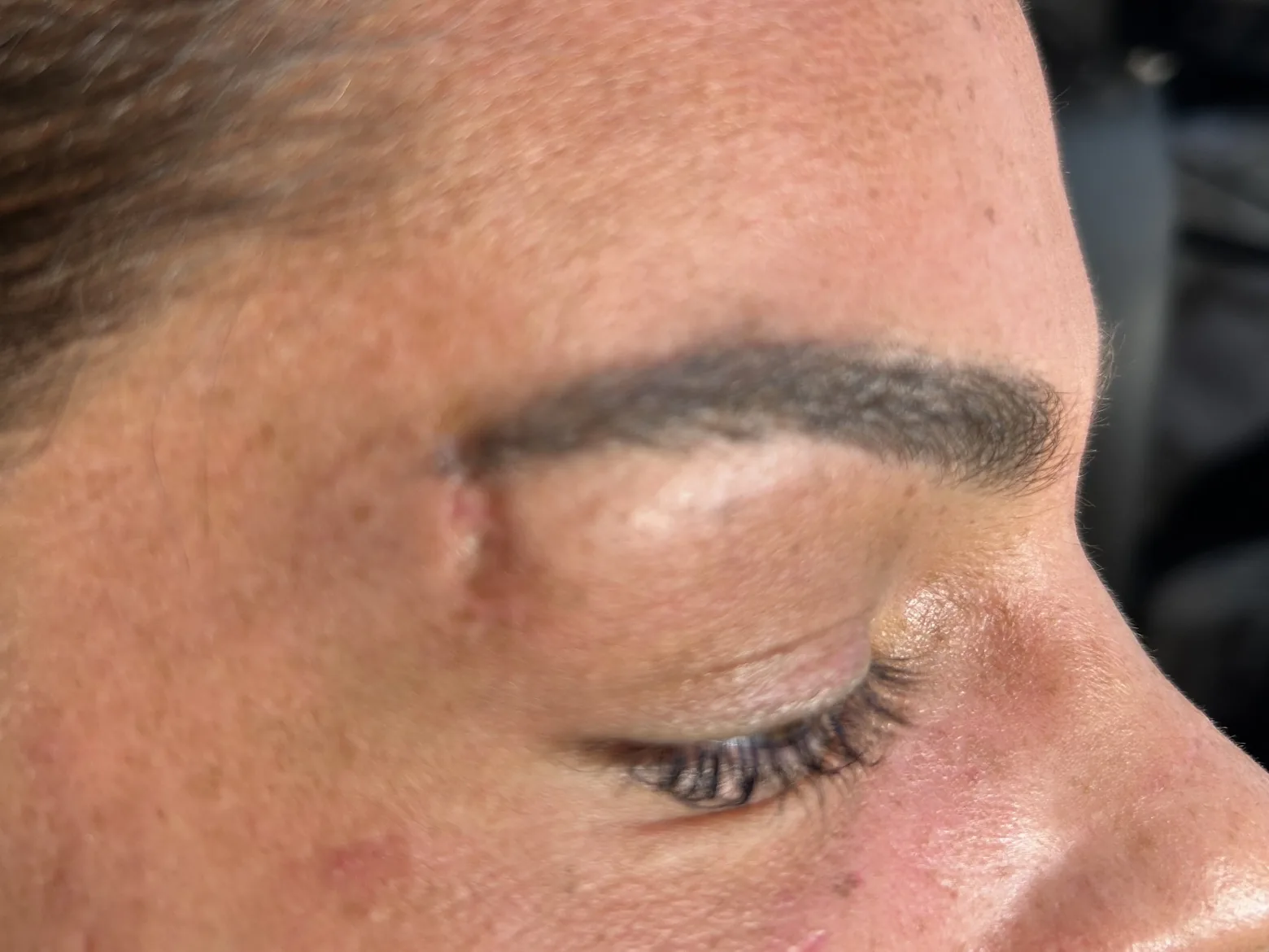 Brow-area scar before inkless scar revision