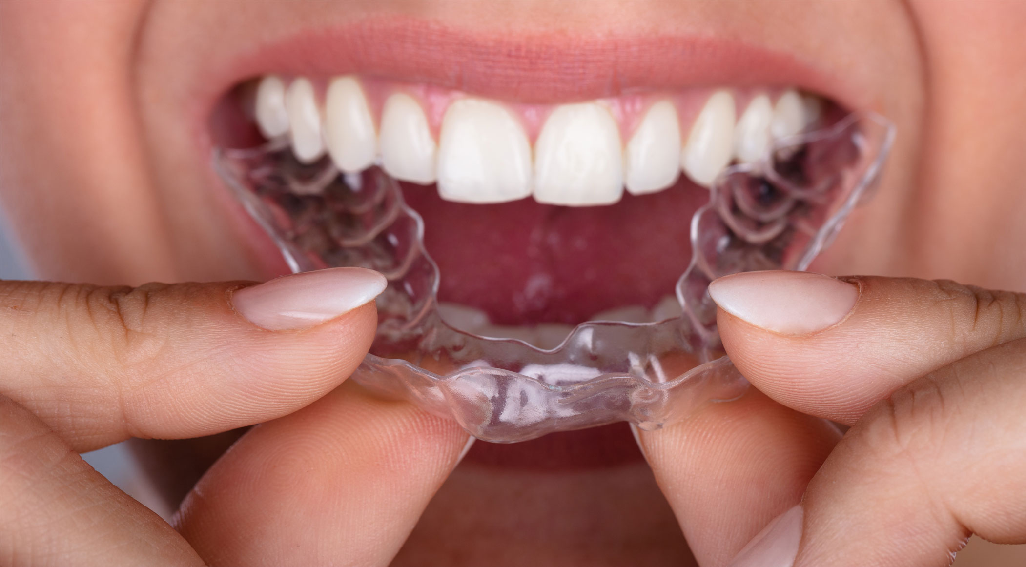 Woman holding invisalign