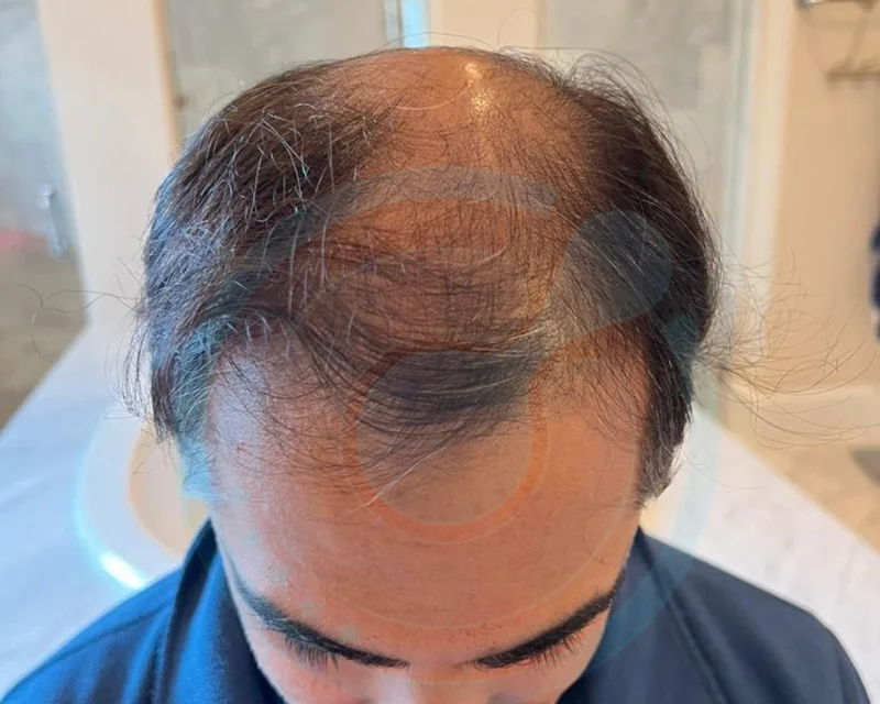 Fronte e vertice, 45+ — Prima