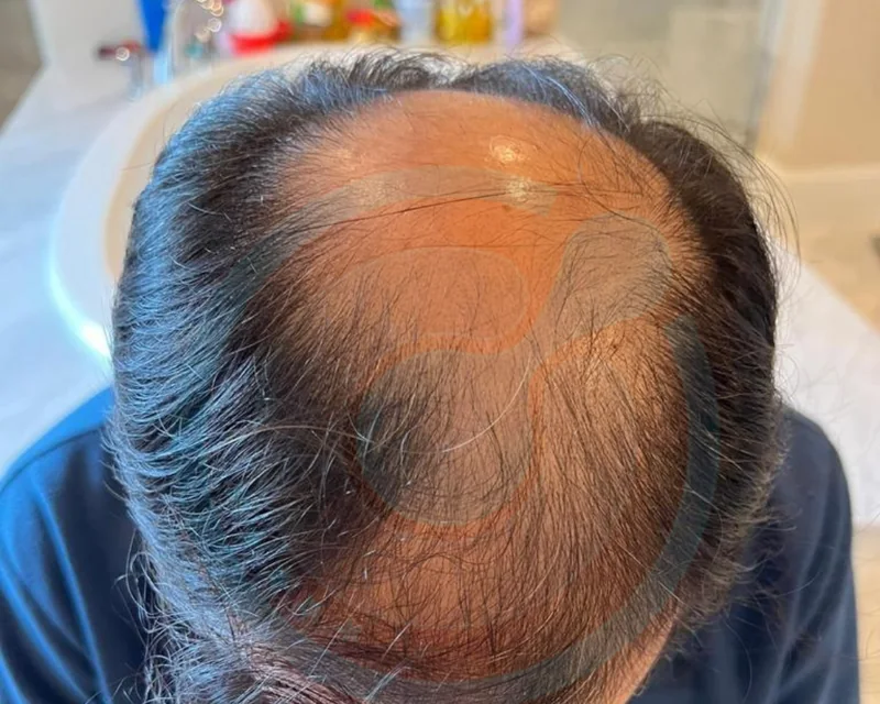 Fronte e vertice, 45+ — Prima