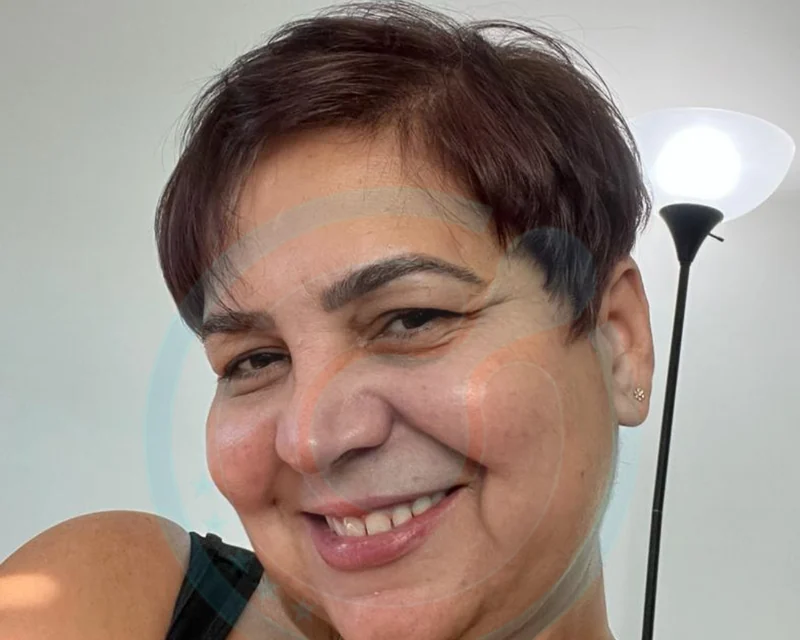 Donna, diradamento diffuso — Risultato
