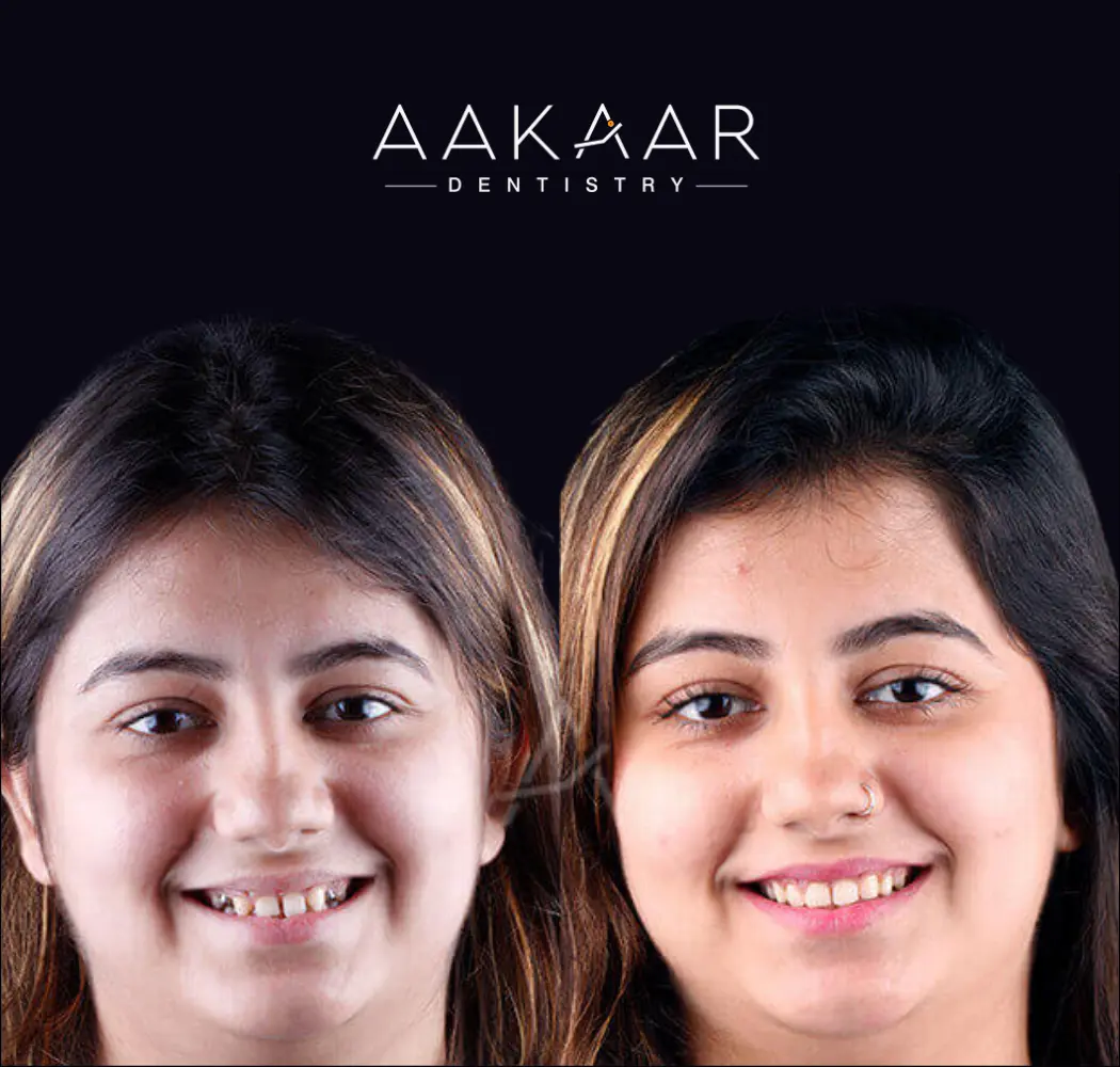 Before and after: smile makeover