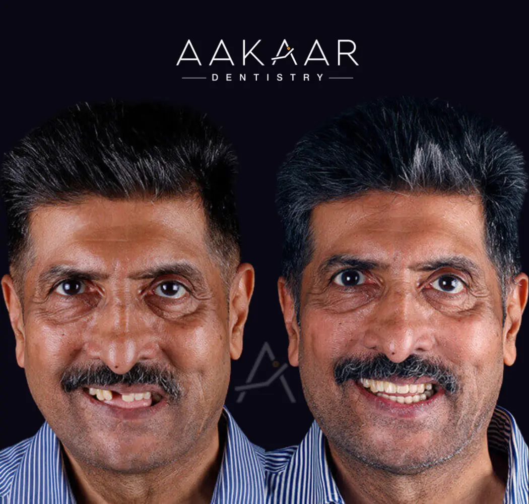 Before and after: missing front teeth