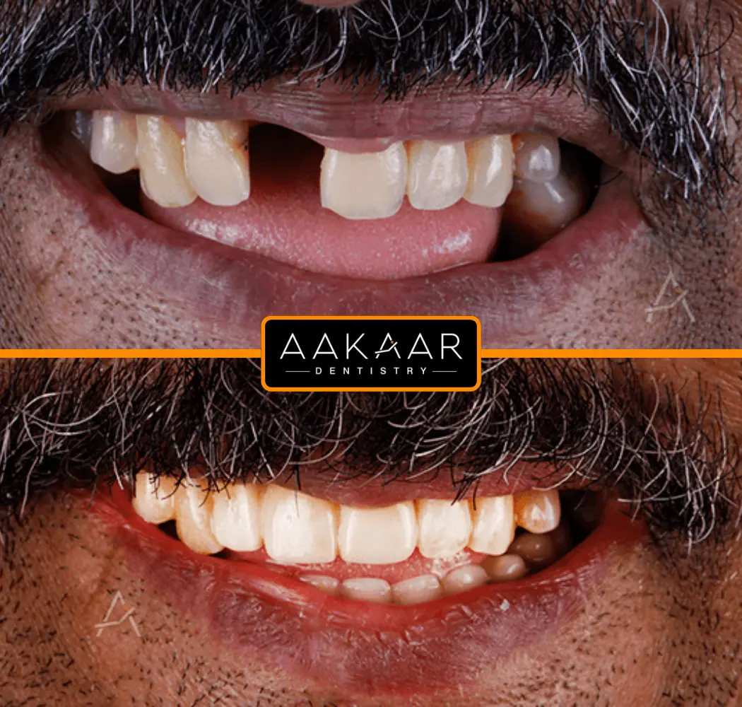 Aakaar patient before and after