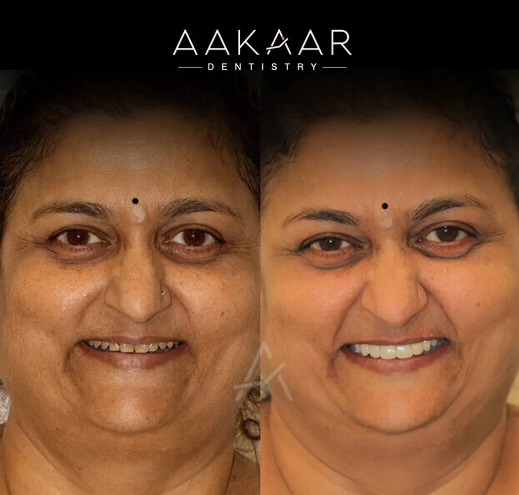 Before and after: brighter, even smile