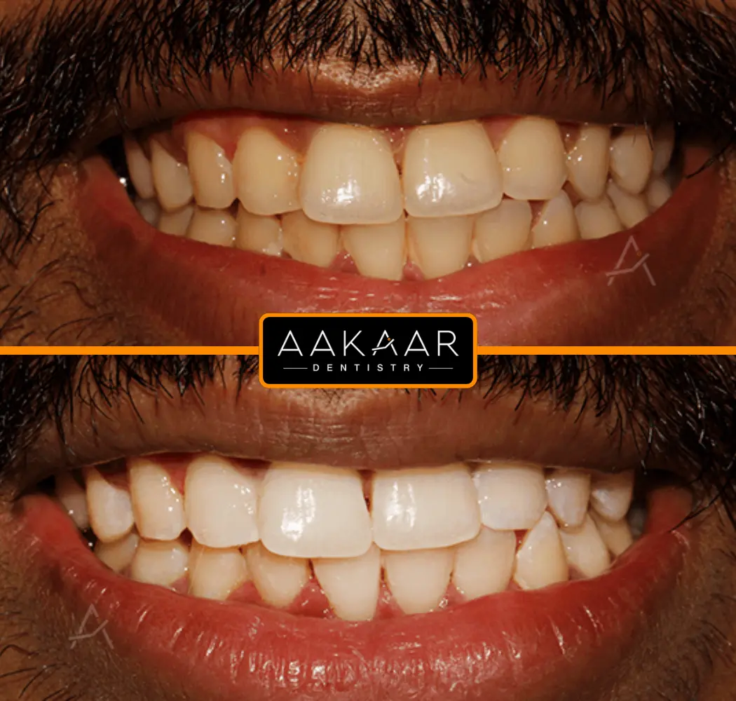 Before and after: stained teeth