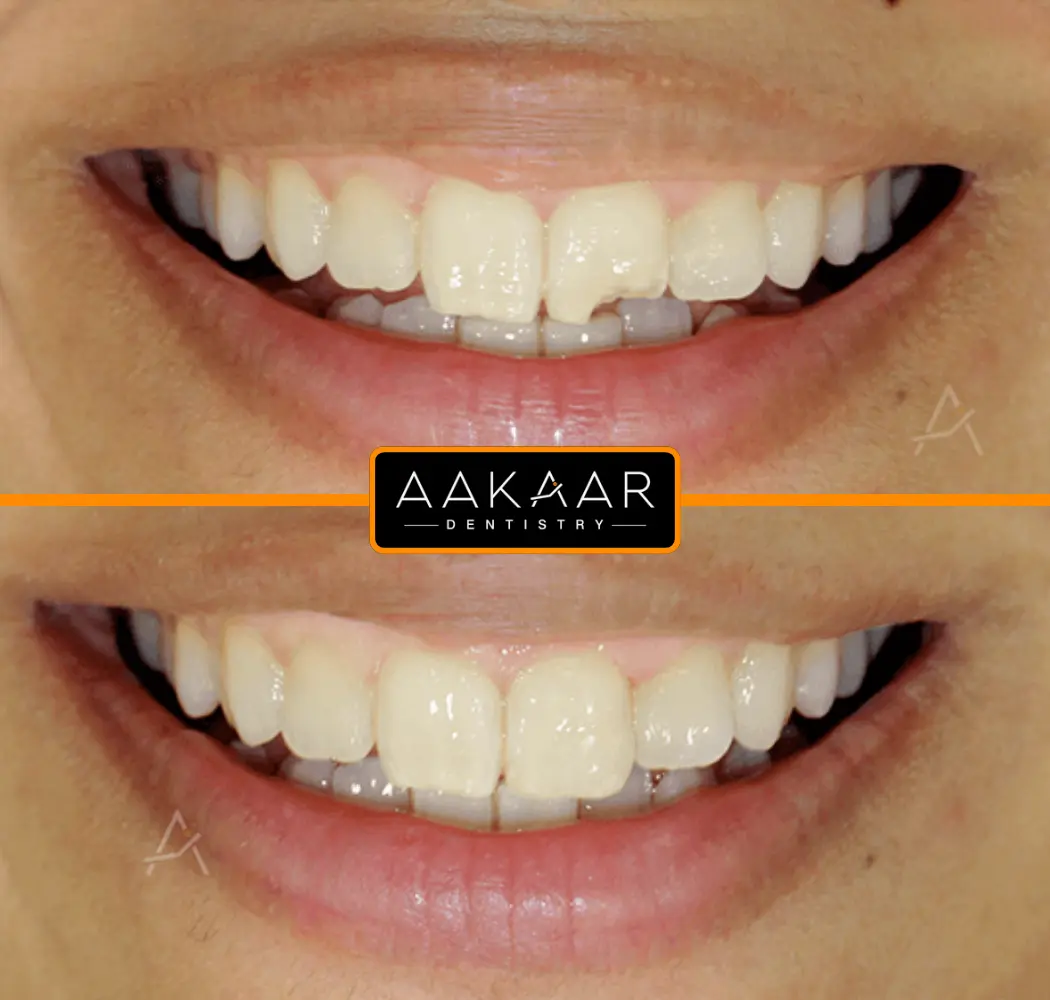 Before and after: chipped front tooth
