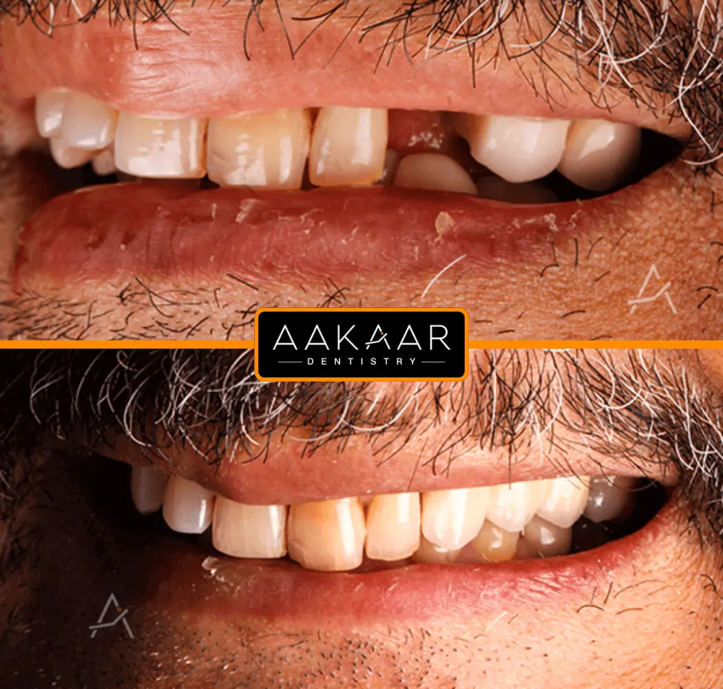 Aakaar patient before and after