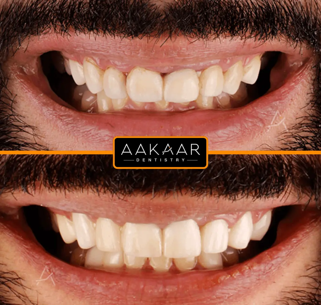 Aakaar patient before and after