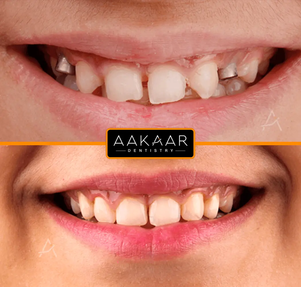 Before and after: gaps and uneven teeth