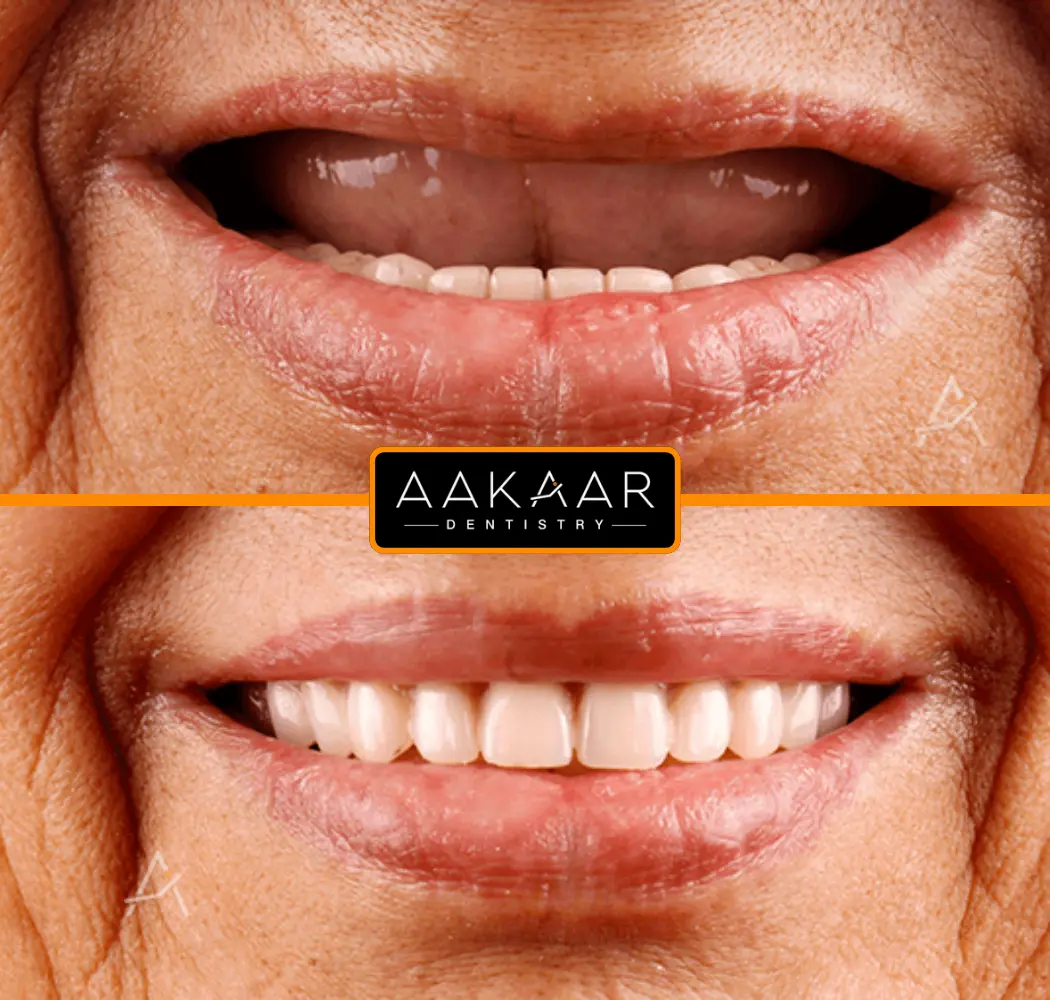 Before and after: full mouth rehabilitation