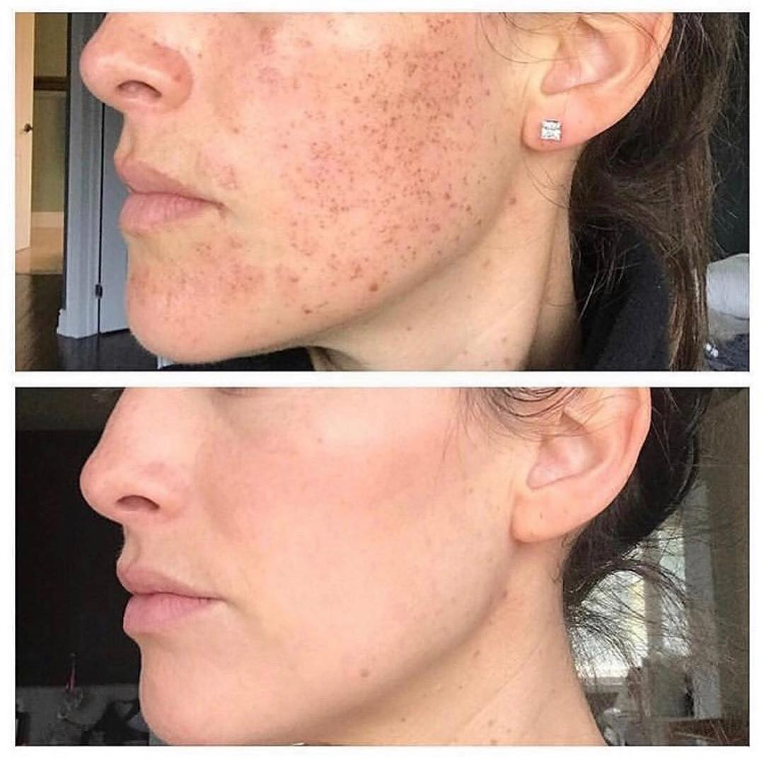 Real client before and after treatment result 34