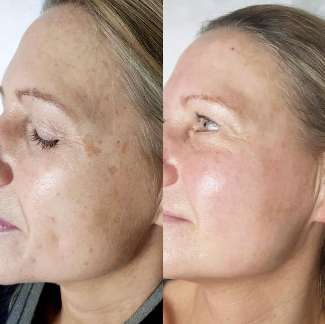 Real client before and after treatment result 35