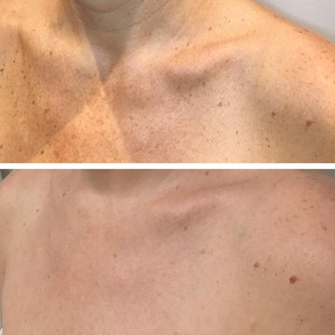 Real client before and after treatment result 37
