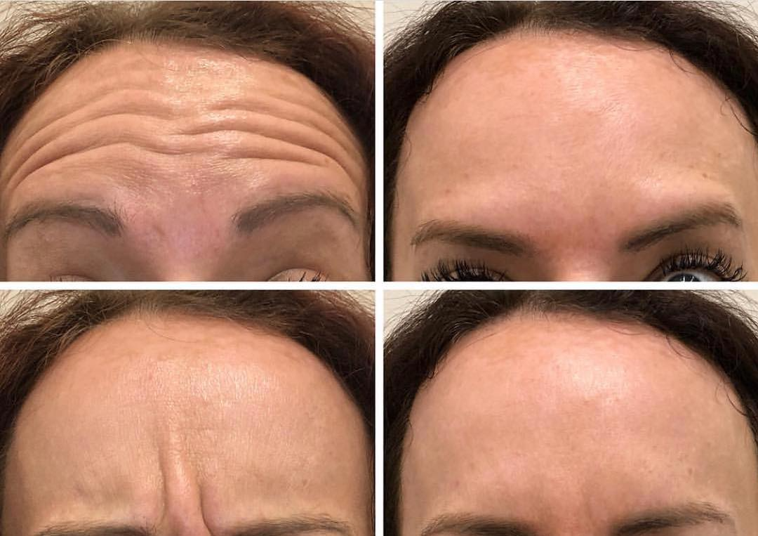 Real client before and after treatment result 38