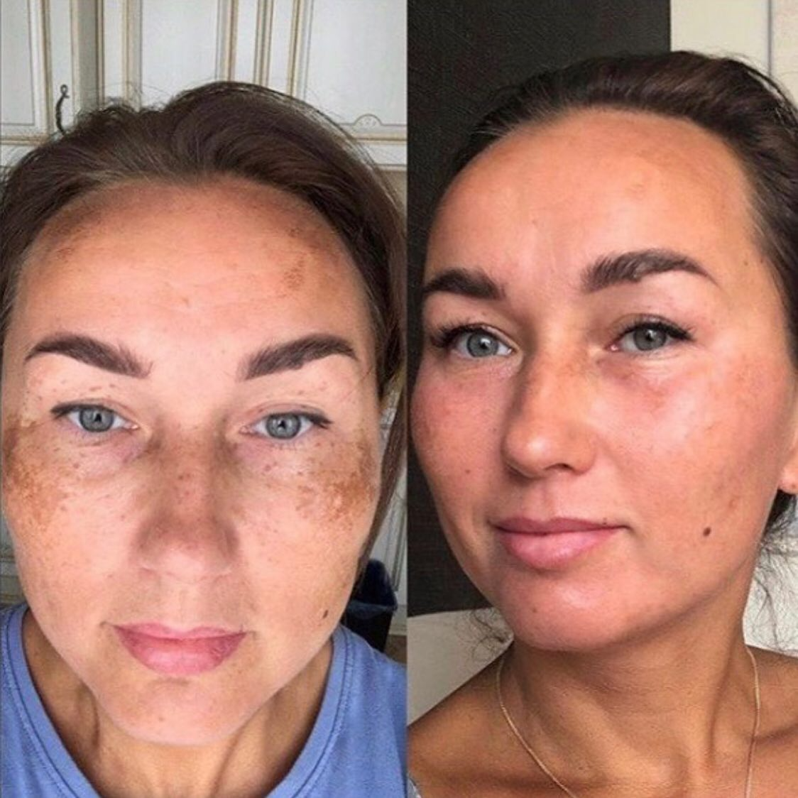 Real client before and after treatment result 31