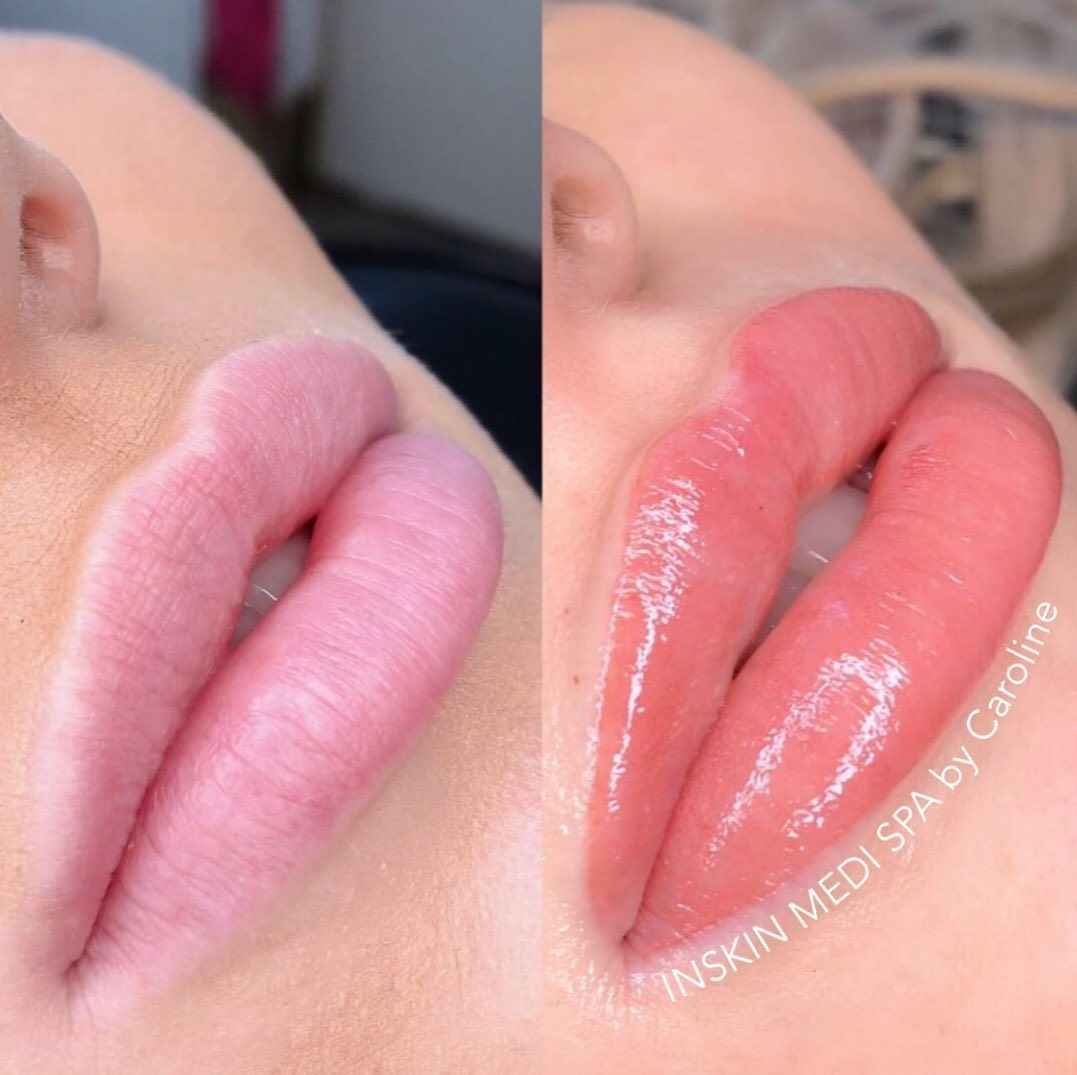 Real client before and after treatment result 32
