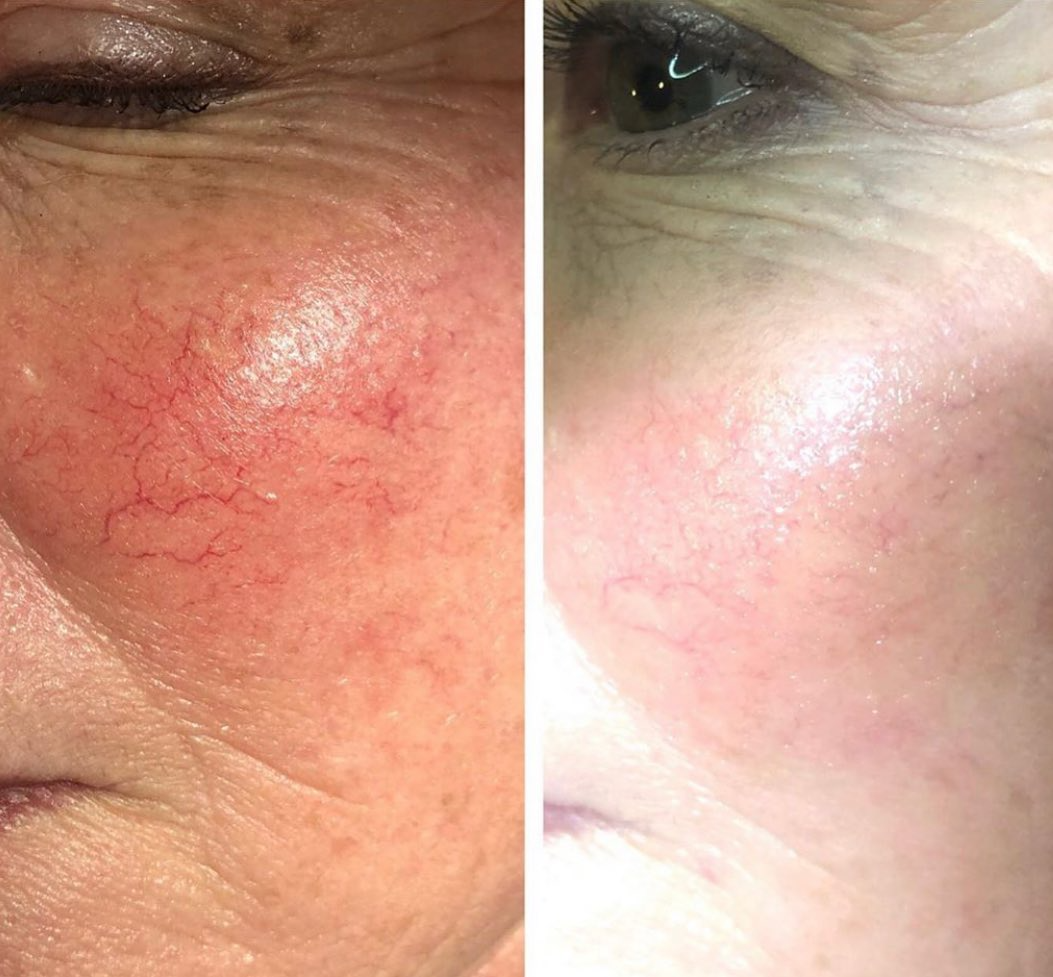 Real client before and after treatment result 29