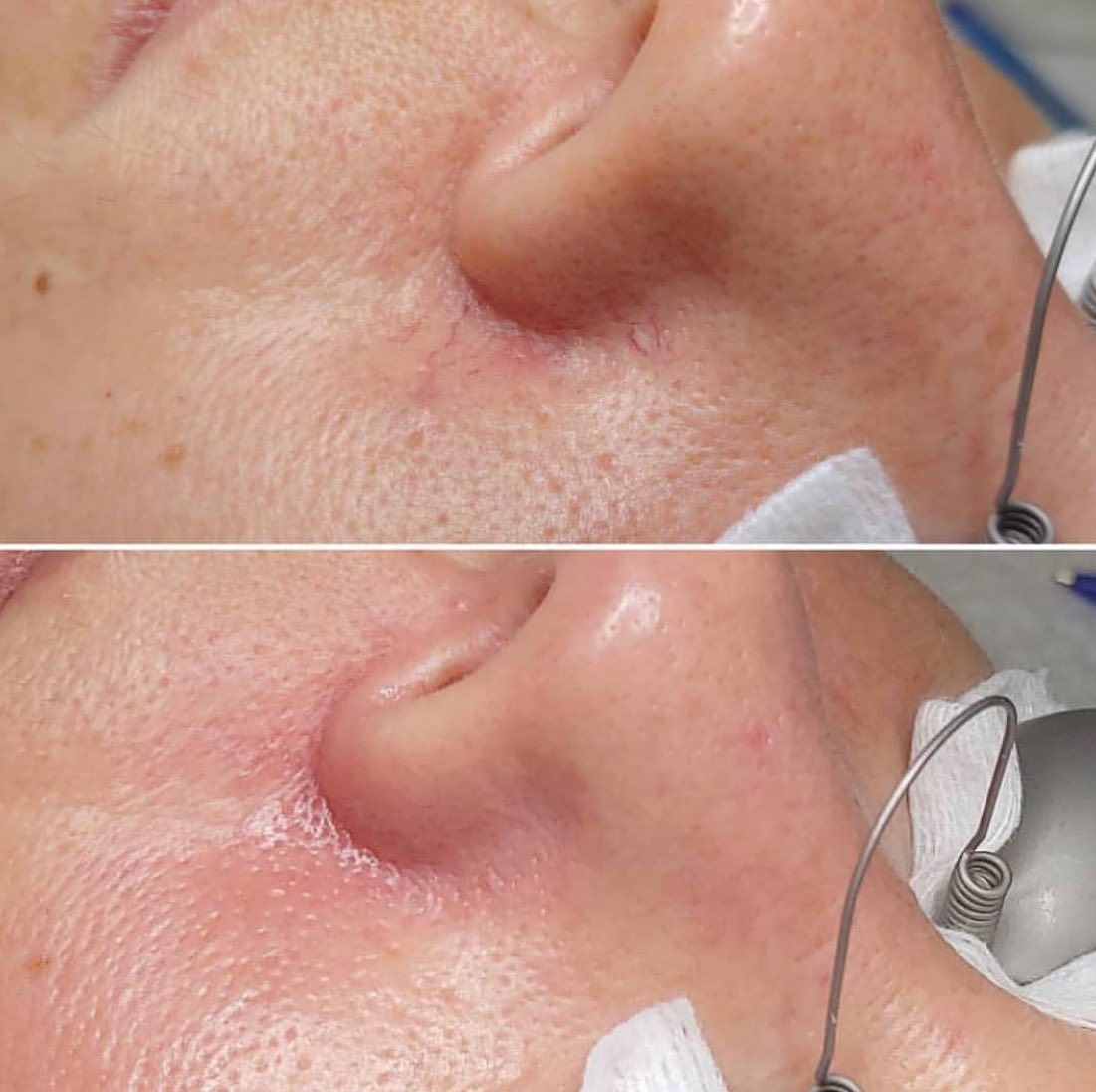 Real client before and after treatment result 30