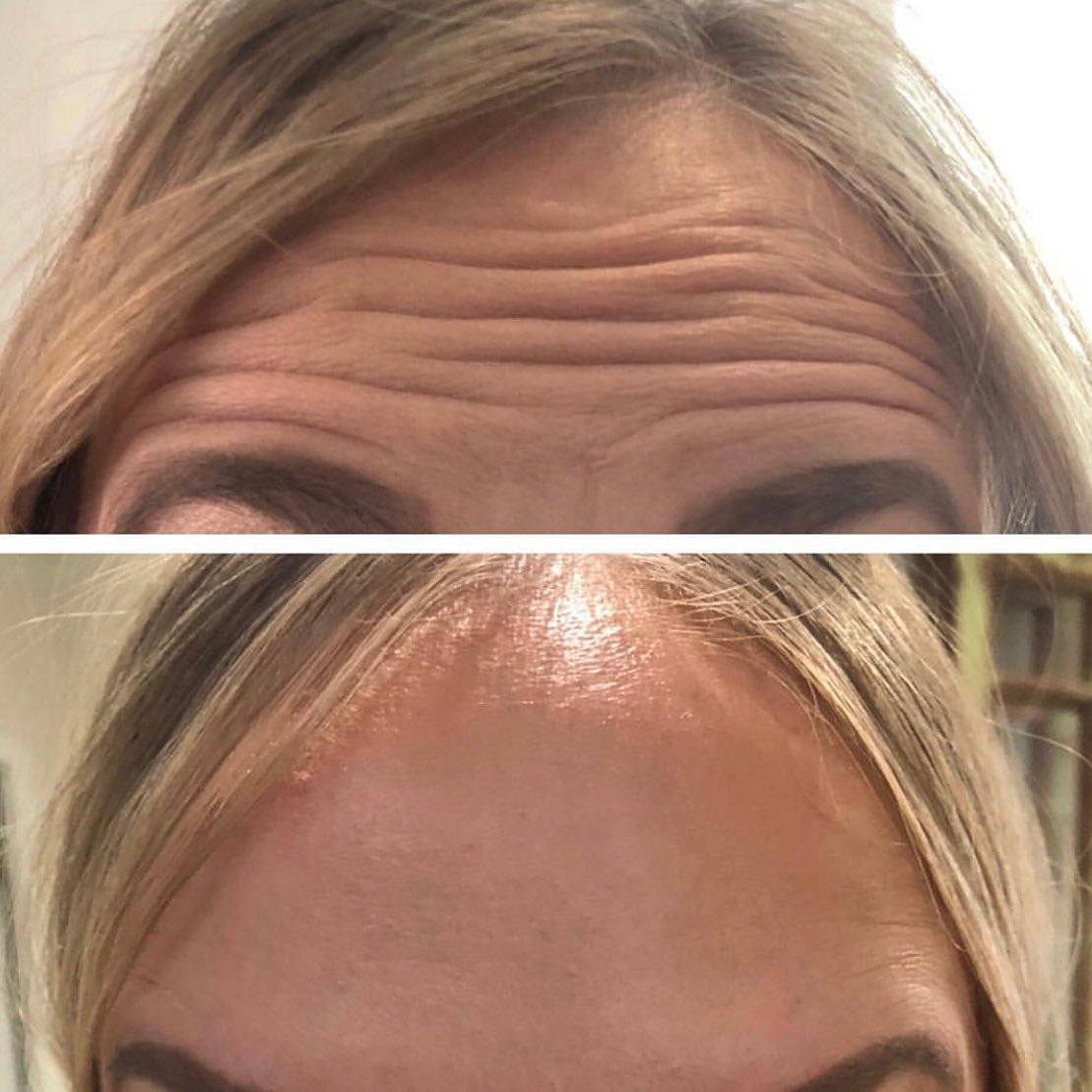 Real client before and after treatment result 26