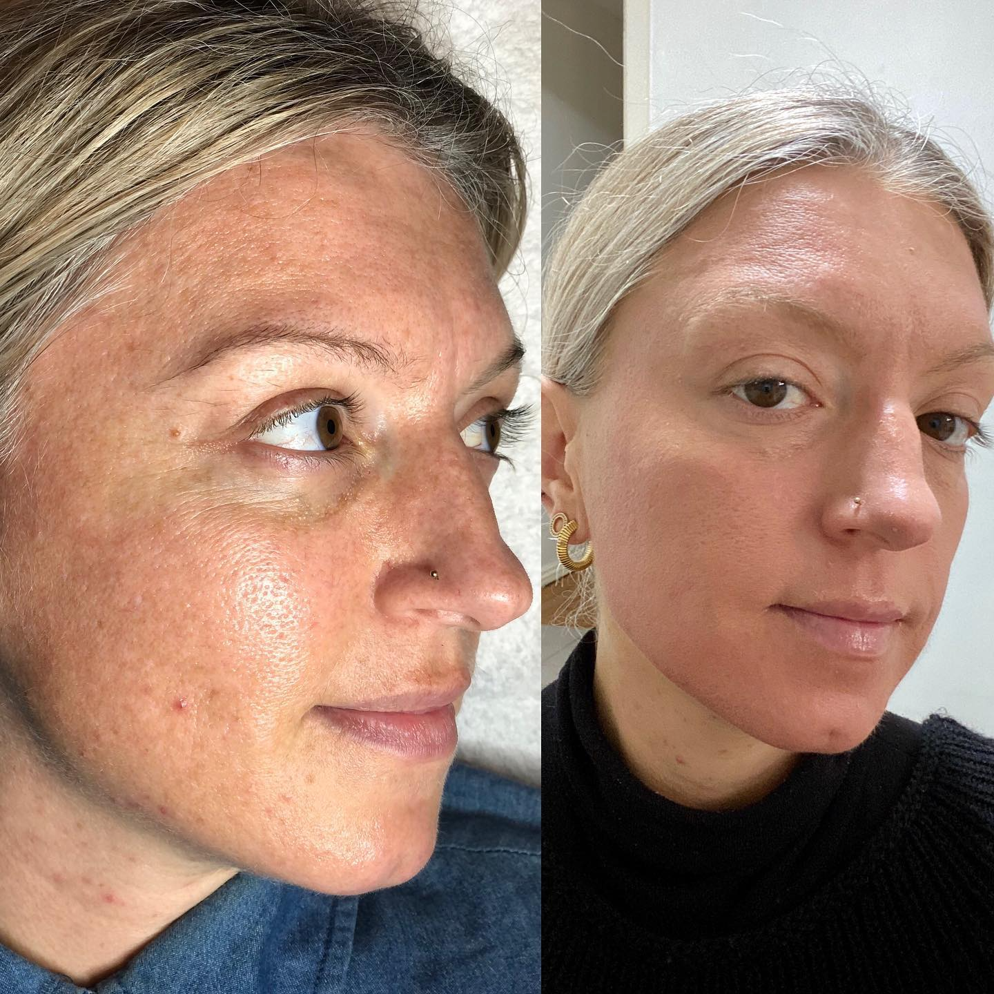 Real client before and after treatment result 23
