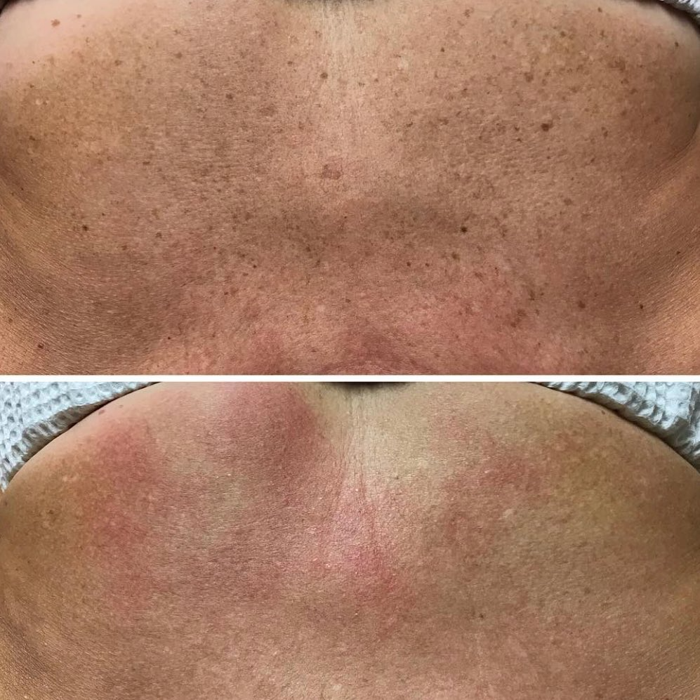 Real client before and after treatment result 25