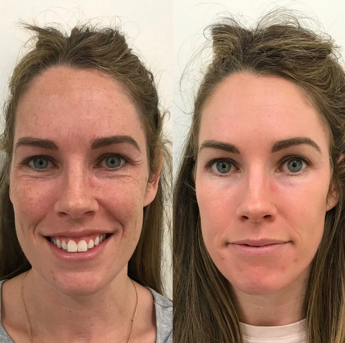 Real client before and after treatment result 22