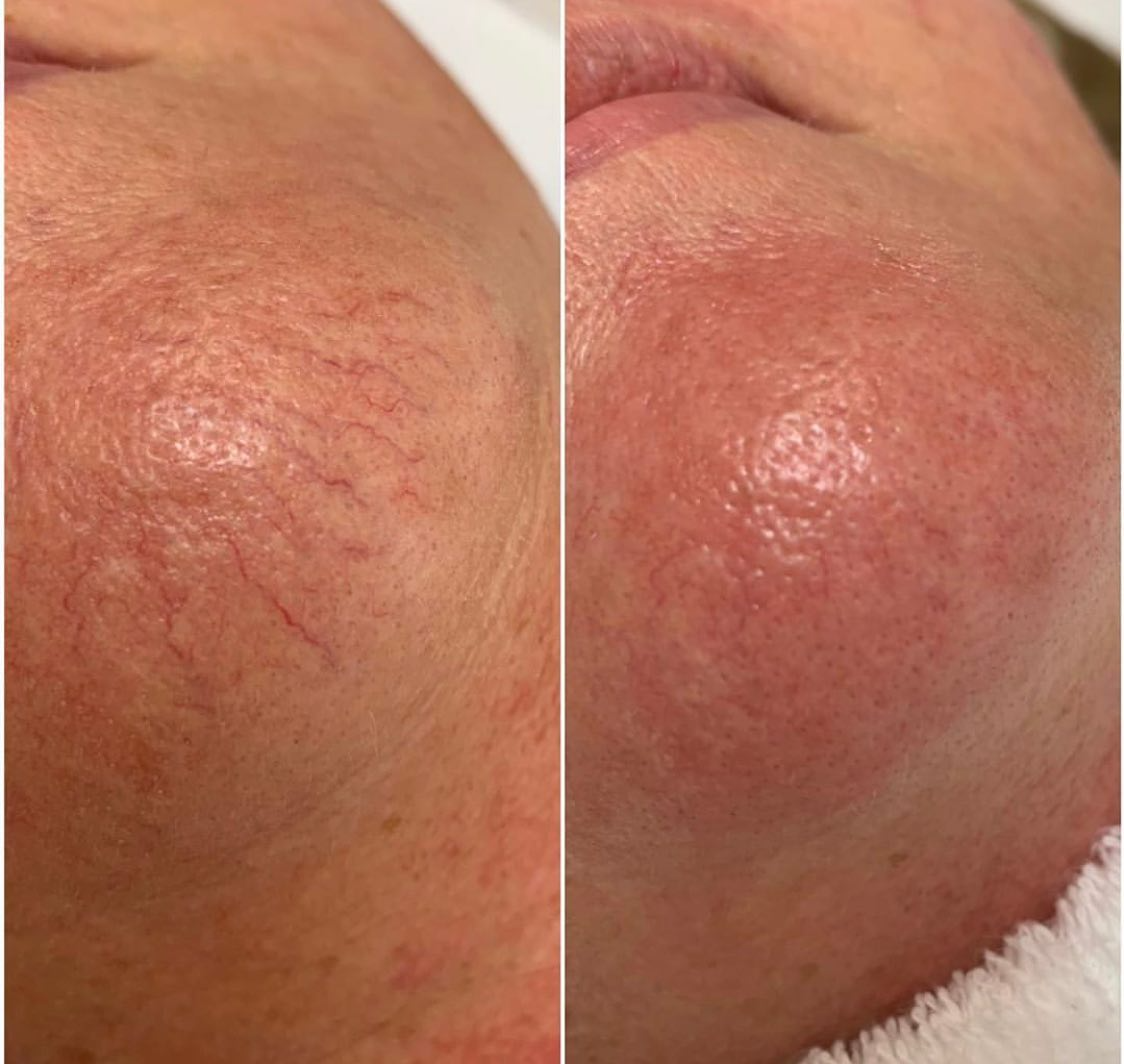 Real client before and after treatment result 20