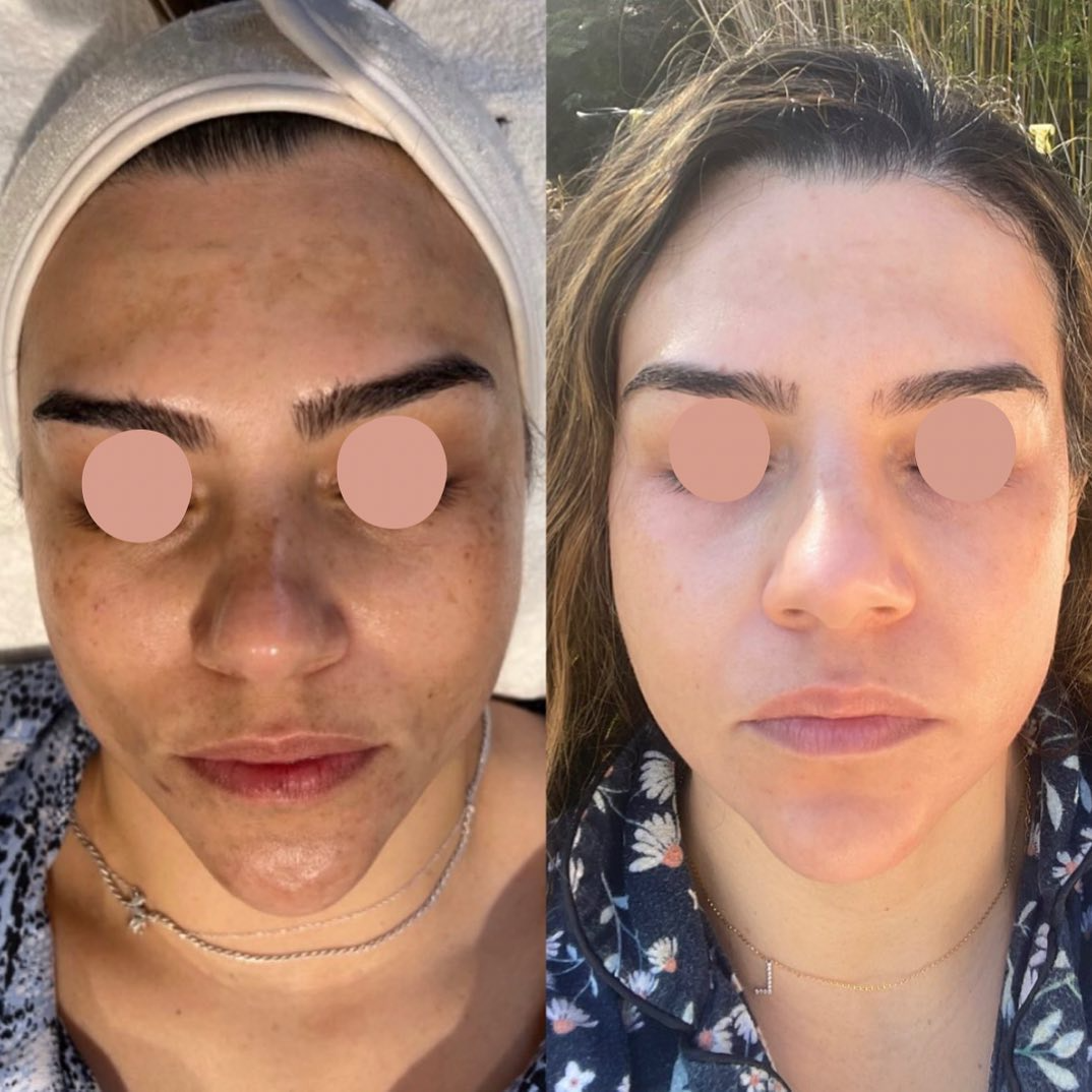 Real client before and after treatment result 18