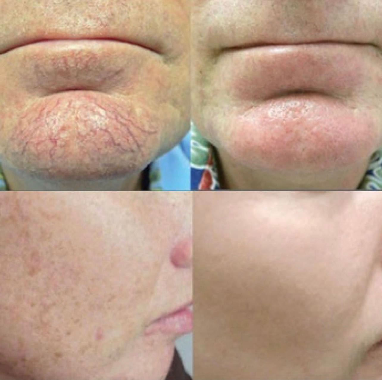 Real client before and after treatment result 14