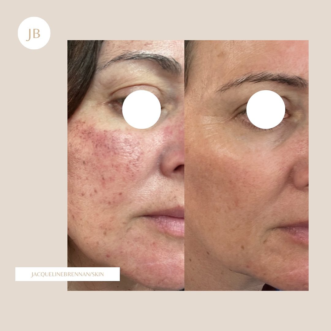 Real client before and after treatment result 15