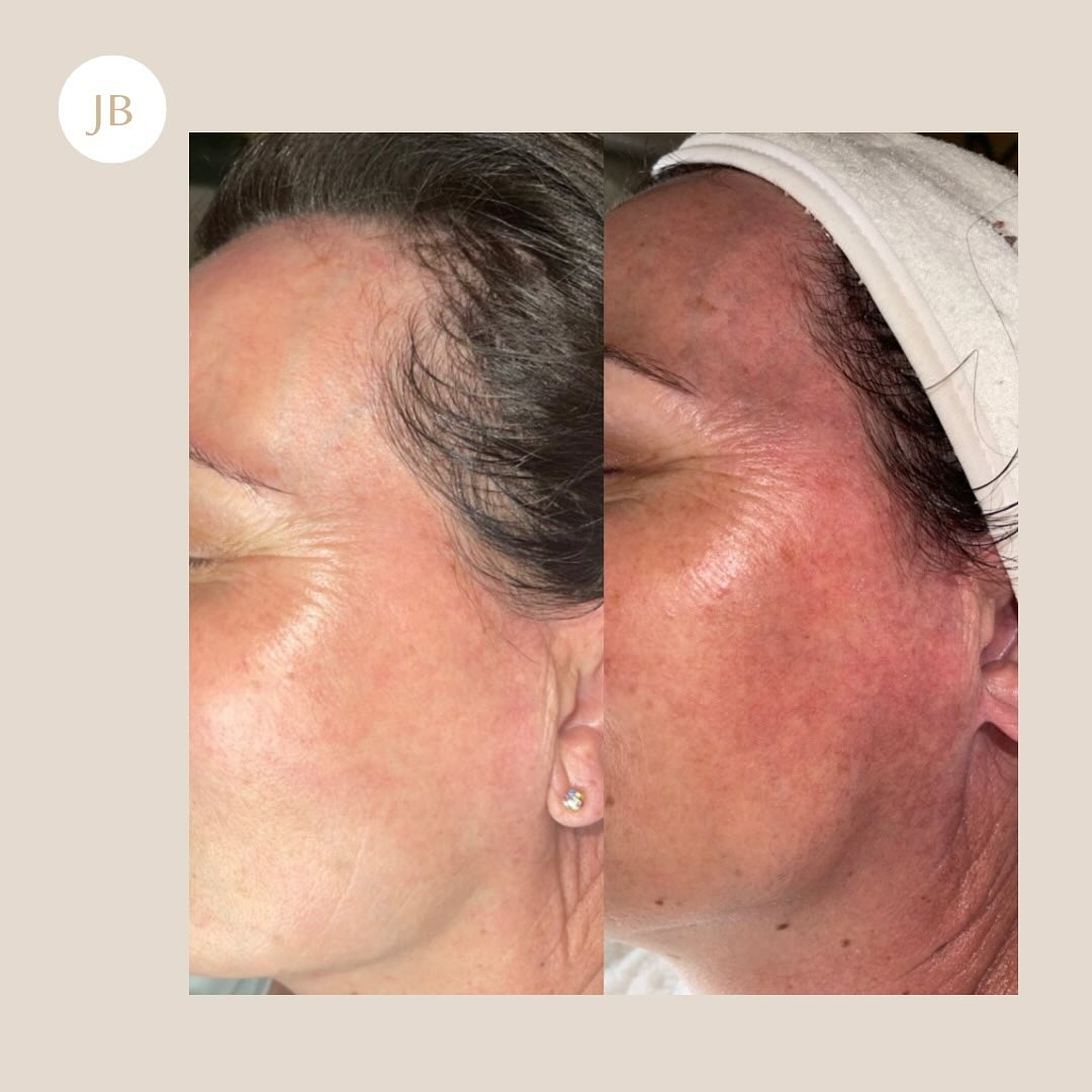Before and after skin treatment result
