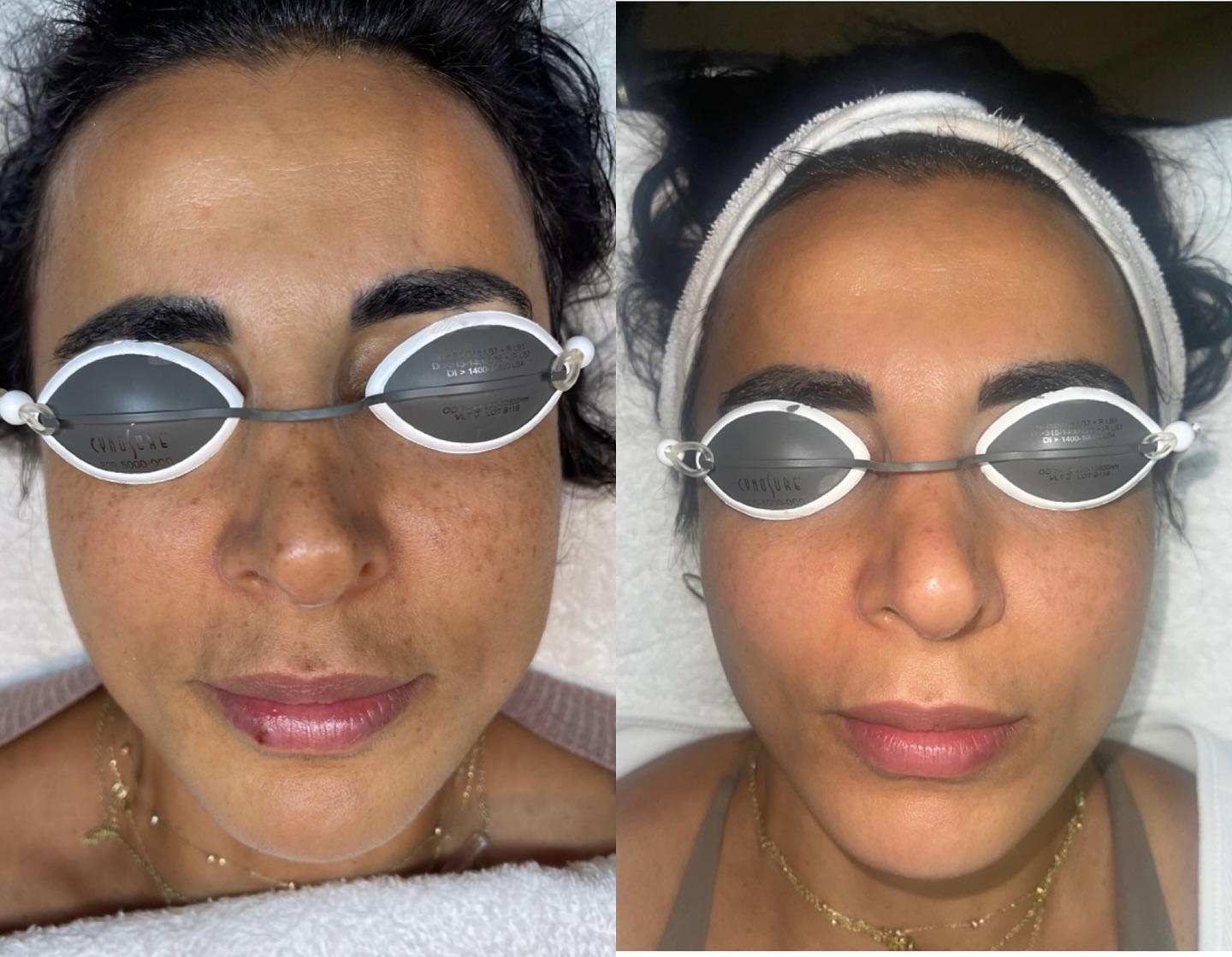 Before and after skin treatment result